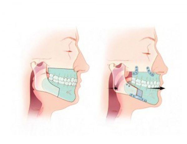 Maxillofacial Surgery For Sleep Apnea Sleep Clinic Dormalab 