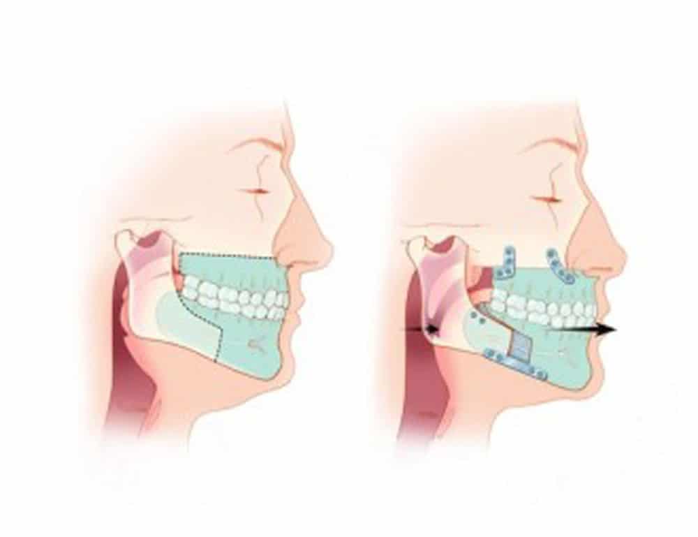 Maxillofacial Surgery