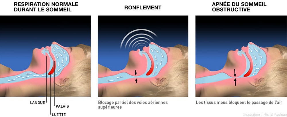 10 Conseils pour diminuer le ronflement